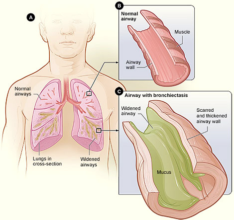 BronchImage Bronchiectasis Diagram