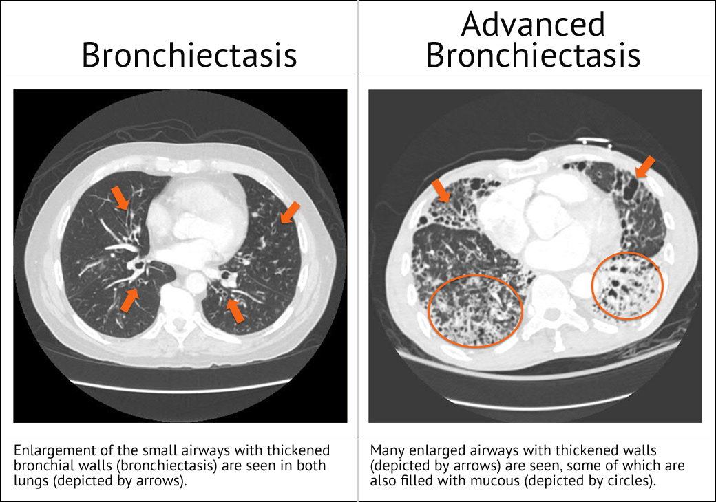 CTScans Bronchiectasis CT Scans
